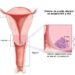 Refuerza el ISSSTE campaña de prevención contra el cáncer cervicouterino