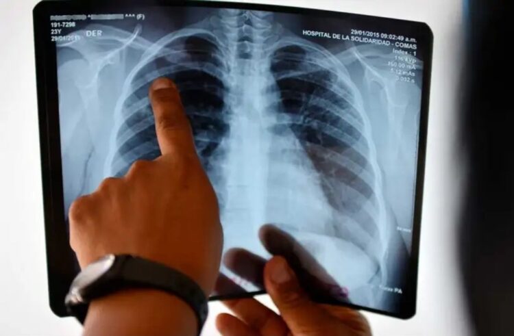 Gigante biotecnológico Angem presenta en México nuevo tratamiento contra cáncer de pulmón