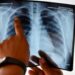 Gigante biotecnológico Angem presenta en México nuevo tratamiento contra cáncer de pulmón