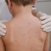 Acumula Chihuahua desde febrero 4 mil contagios y 14 decesos por sarampión y 2 por dengue