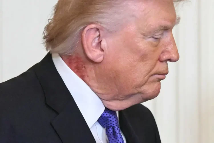 Suma EU dos alertas a un tiempo: embates de Irán y extrañas manchas en cuello y manos de Donald Trump